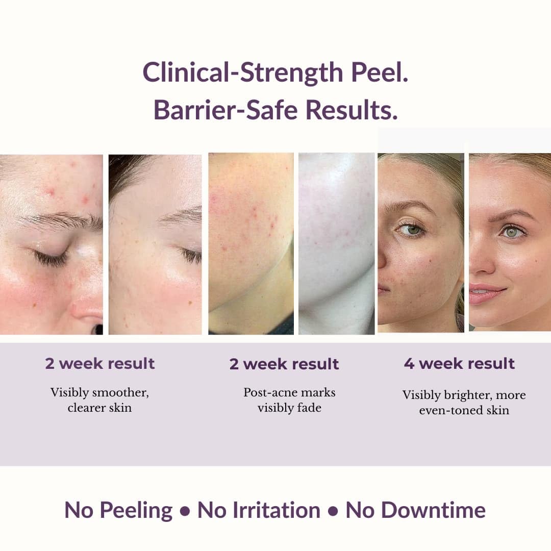 MAXDAHLIA Petal Peel 20% AHA Serum – Lactic + Mandelic Acid Chemical Peel for Dark Spots & Acne Marks | Bakuchiol Night Treatment | No Downtime | Safe for Sensitive & Acne-Prone Skin