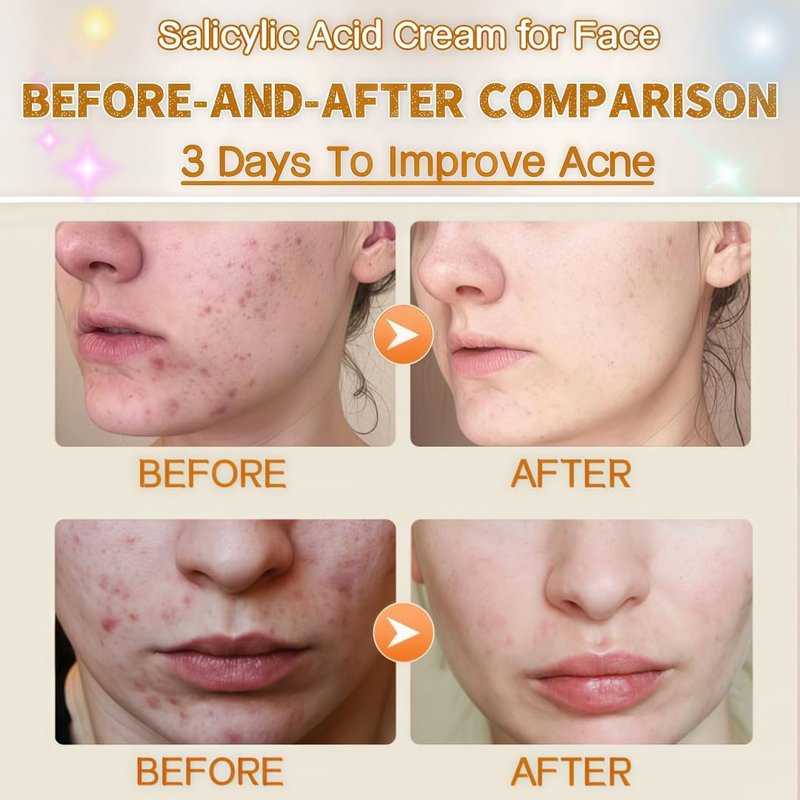 Salicylic Acid Acne Face Cream for Oily & Sensitive Skin – Oil Control, Acne Treatment, Pore Minimizer, Moisturizing & Repairing Damaged Skin – Non-Comedogenic, Gentle Formula, 50ml / 1.69oz