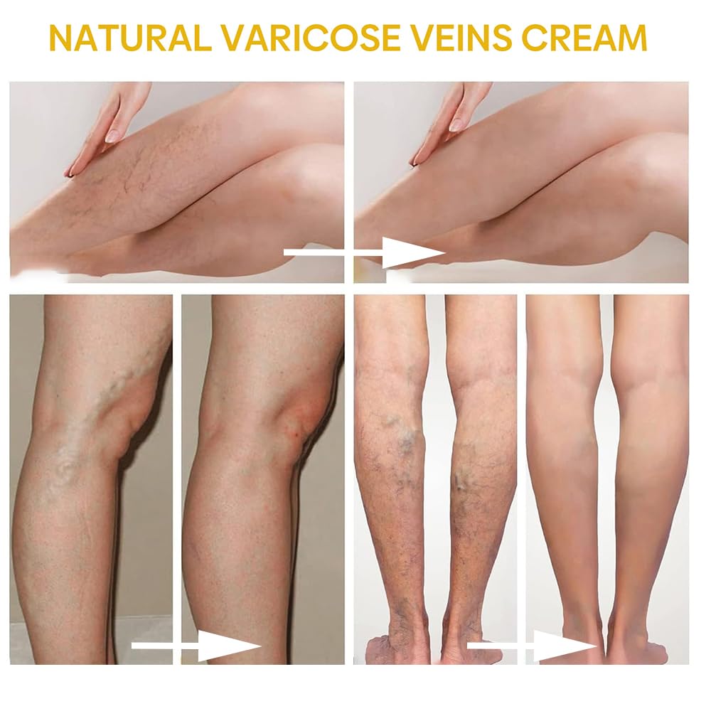 etitek 2PCS Bee Venom Varicose Veins Cream for Legs，Moisturizing Leg Creams Natural Ingredient Leg Care 4oz/120g