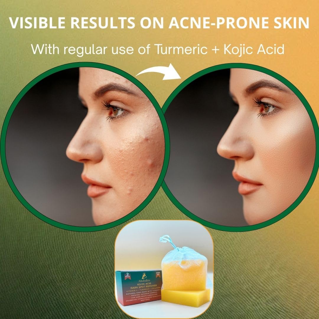 Altobello's Turmeric Kojic Acid Soap - Dark Spots Remover for Face & Body, Brightening Skin Lightening Bar with Vitamin C, Collagen, Hyaluronic Acid - 2 Bars + Exfoliating Net.