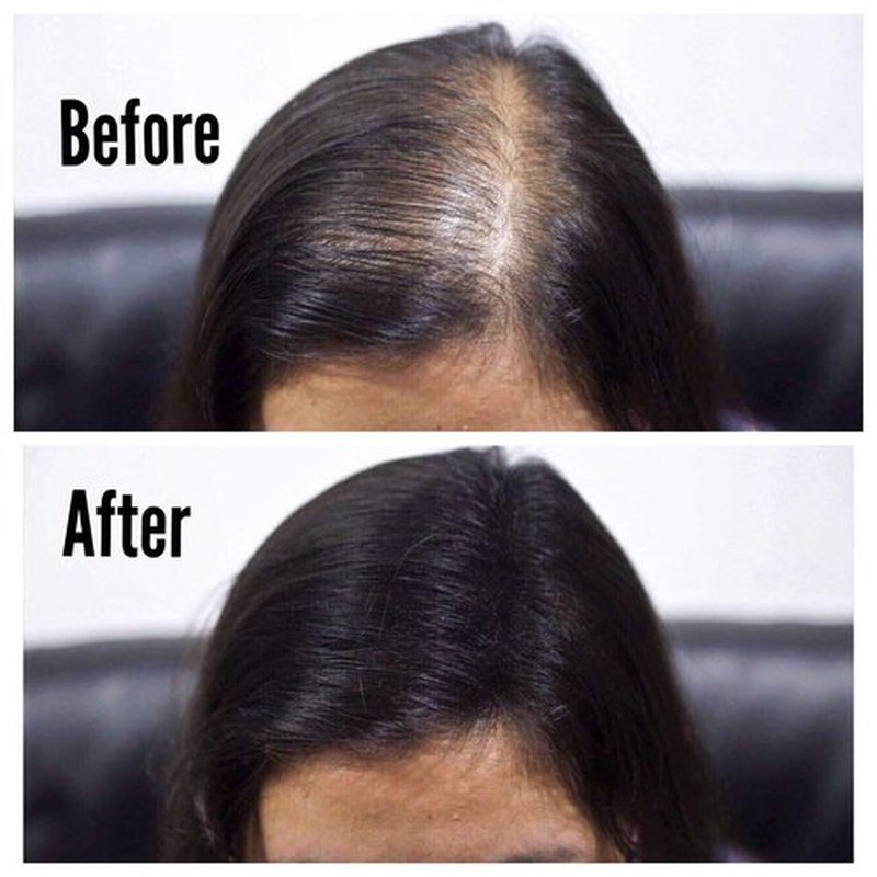 THICK FIBER Hair Fibers for Thinning Hair & Bald spots (BLACK) - 25g Bottle - Conceals Hair Loss in Seconds - Hair Powder for Women & Men