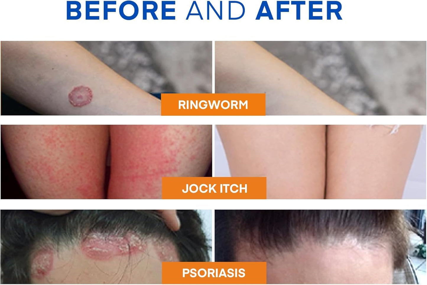 Antifungal Ringworm Treatment Body Wash - Antibacterial Wash with 1% Tolnaftate & Tea Tree Oil for Ringworm, Jock Itch, Tinea, Back Acne & Foot Odor on back, chest, groin, feet for Men and Women 500ml