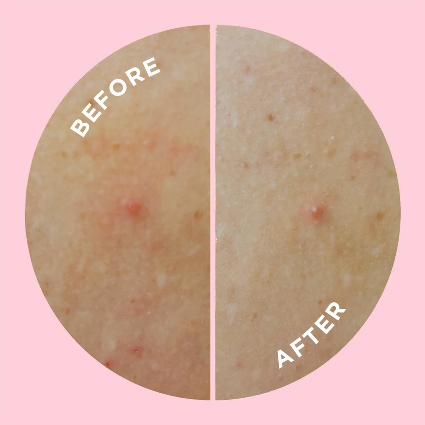ZitSticka Large Pimple Patches for Face and Body, Goo Getter Hydrocolloid Patches to Cover Zits & Blemishes, Acne Patches or Zit Spot Stickers, Blemish Patch (Body Patch 9 Pack)