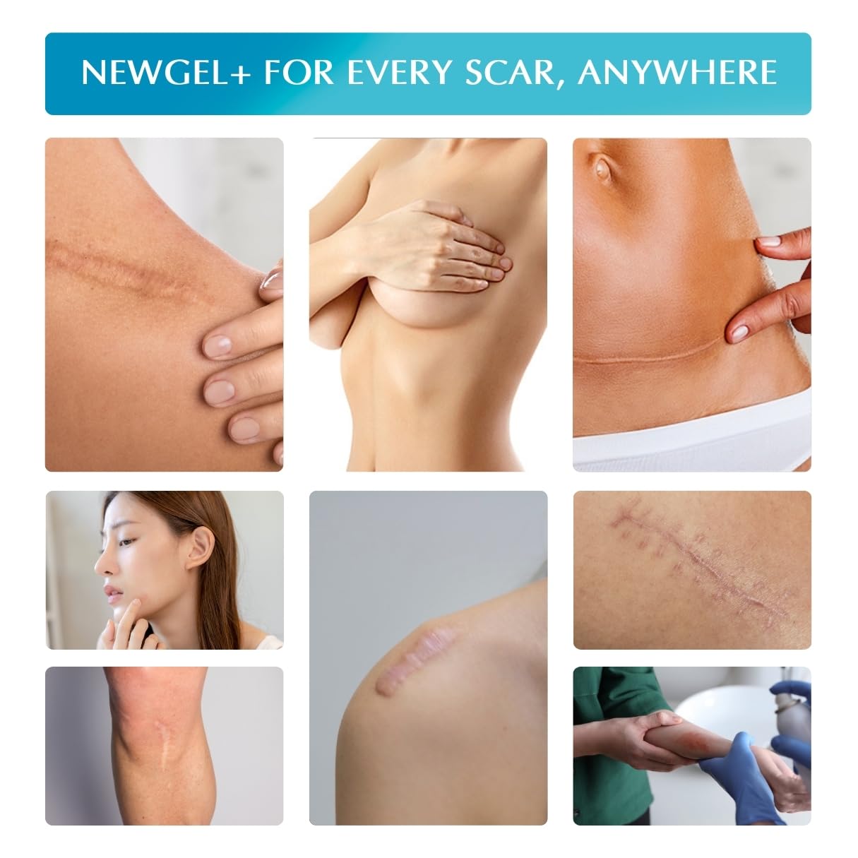 MyNewGel Advanced Silicone Scar Treatment Sheets | Old, New Scars, Surgery, Keloids, C-Section, Burns | 1" x 3" Sheet (3 Count) - Clear