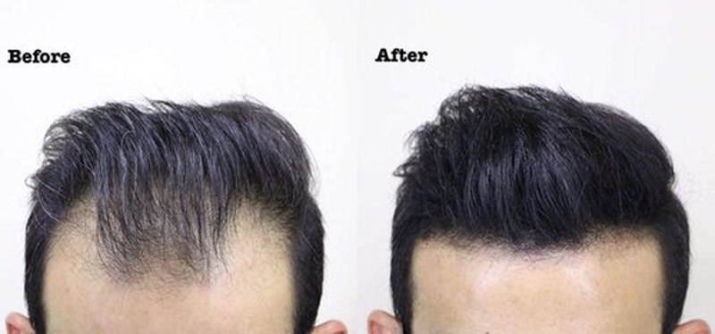 THICK FIBER Hair Fibers for Thinning Hair & Bald spots (BLACK) - 25g Bottle - Conceals Hair Loss in Seconds - Hair Powder for Women & Men