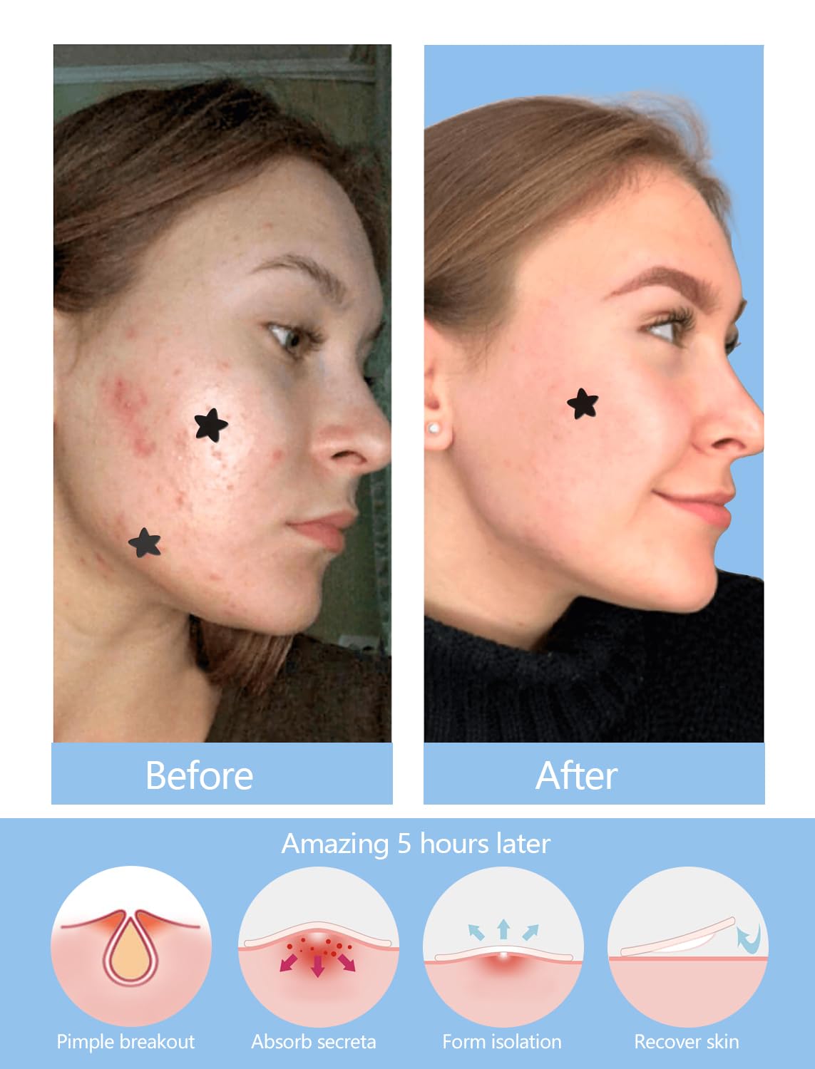 ZHAOLIESM 306 Counts Black Star Pimple Patches for Face, Hydrocolloid Star Acne Patches Refill, Cute Zit Covers for Face, Spot Stickers with Tea Tree, Salicylic Acid and Cica Oil