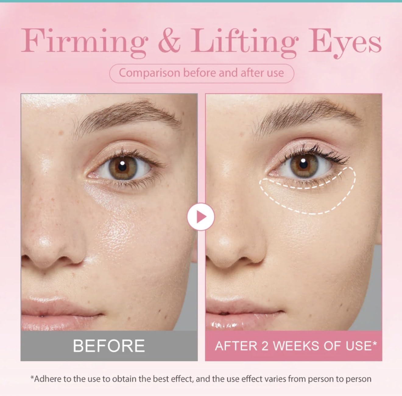BEAUTIVANA KOEC Bomb Lifting Eye Gel with Retinol, Collagen Extract, Niacinamide, Mentha Arvensis Leaf, Anti-Aging Under Eye Treatment for Dark Circles and Fine Lines