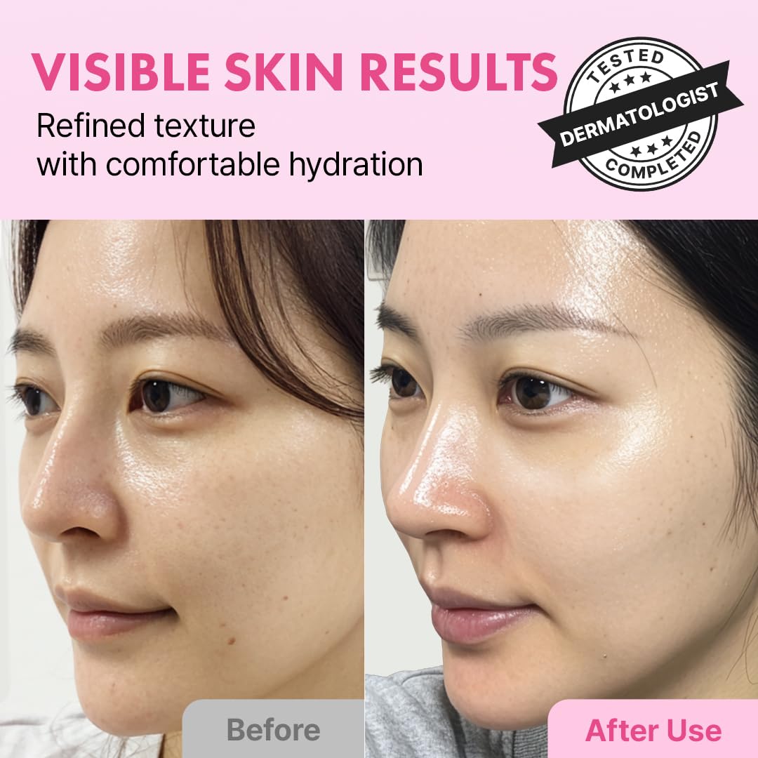 Hanskin Hyaluron Exfoliating AHA Treatment – Korean Exfoliating Toner with Glycolic & Lactic Acid for Smooth, Hydrated, Glass Skin | pH-Balanced Daily Skin Booster for Dull, Dry Skin, 5.07 fl oz