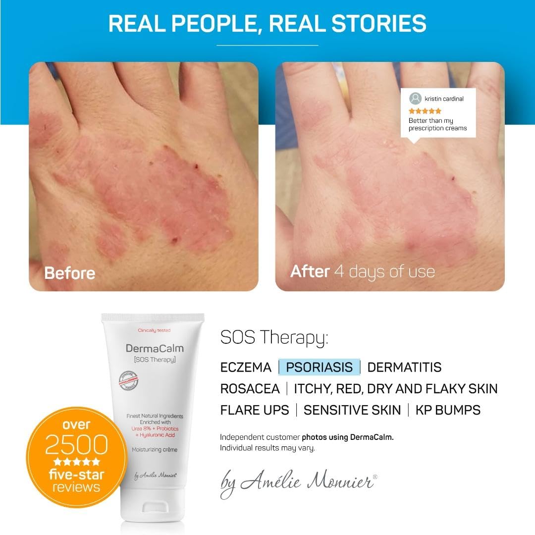 Clinically Tested DermaCalm SOS Therapy - Eczema Psoriasis Dermatitis Prone, Dry Skin - Urea 8%, Probiotics w/Best Natural Ingredients - Itchy, Severely Dry, Scaly Skin. Adults & Kids, Eczema Cream