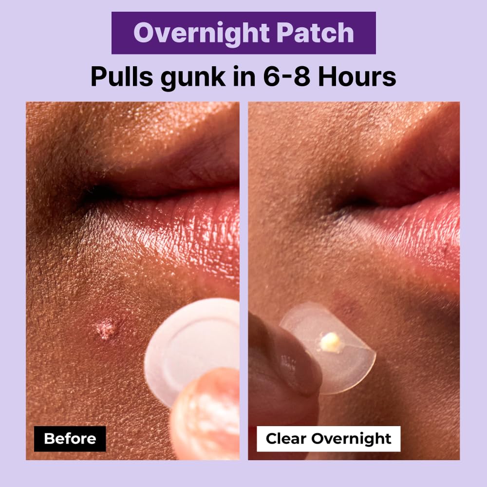 PGB A-CLEAR SPOT Pimple Patches, 3 Sizes – Day & Night Hydrocolloid Acne Patches – Invisible, Absorbs Zits & Blemishes, Korean Skin Care (174 Count)