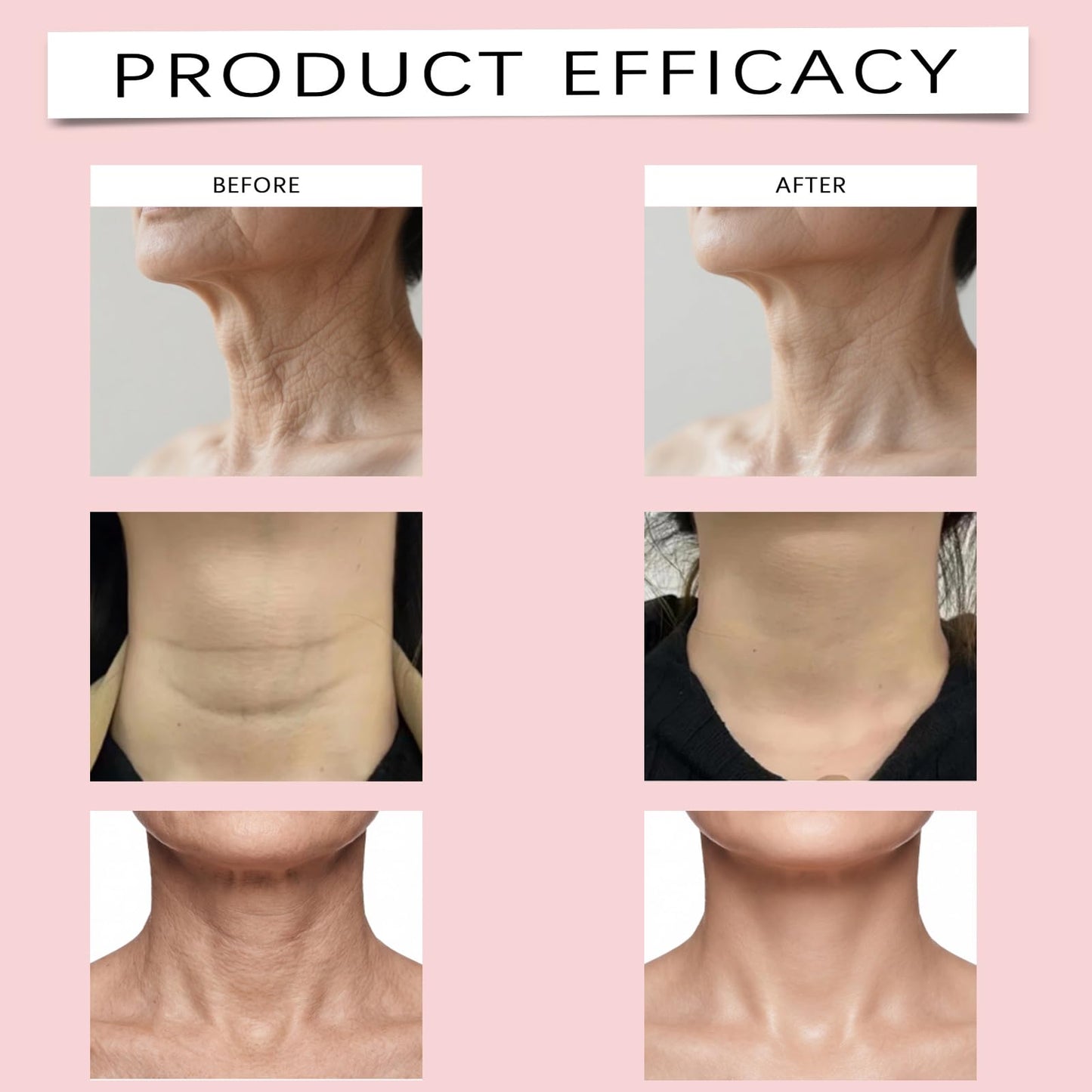 Derperzi Celloa Neck Patch, Collagen Neck Wrinkle Patches, with Peptide + Hyaluronic Acid, Tighten Sagging Wrinkles, Anti Aging & Deep Hydration, 5 Pairs/Box