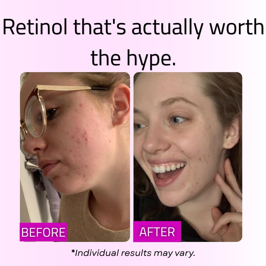 GLEOW Retinol Serum for Face with Hyaluronic Acid and Vitamin E, Gentle Retinol Face Serum Targets the Appearance of Fine Lines and Wrinkles, 2oz