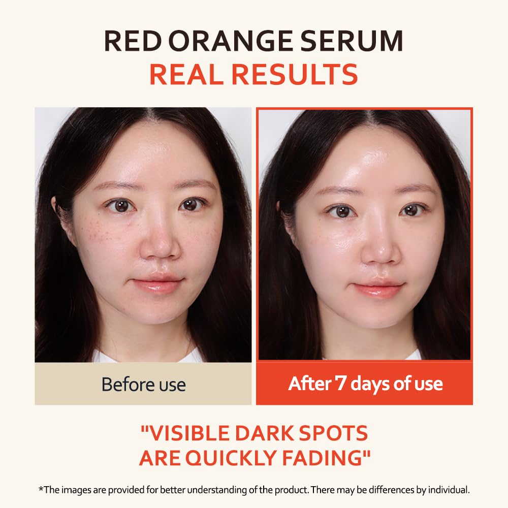 T'else Red Orange Niacinamide Serum 30ml, 1.05 Fl.oz, Blemish and Skin Flaws Improvement, Moisturizing Gel Formula Lotion, Rich Vitamin & Panthenol Facial Care, Smooth Skin Texture, Korean Skin Care