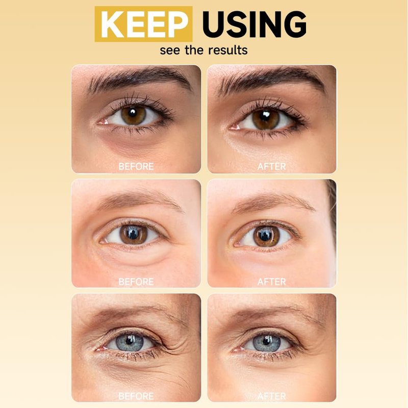 5% PDRN Under Eye Patches - 6-in-1 Bio-Collagen Eye Mask for Puffiness, Dark Circles & Wrinkles | 2% Caffeine, Kojic Acid, Retinol