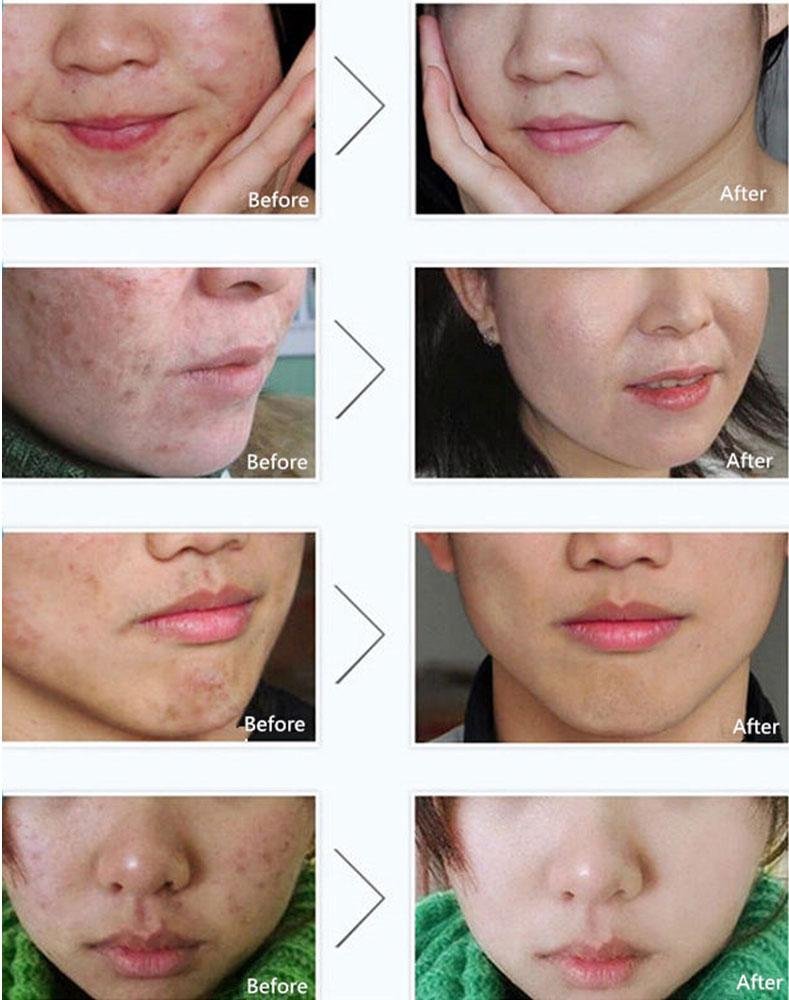 BIOAQUA Acne Scar Blemish Gel Spot Removal Oil Control Face Cream