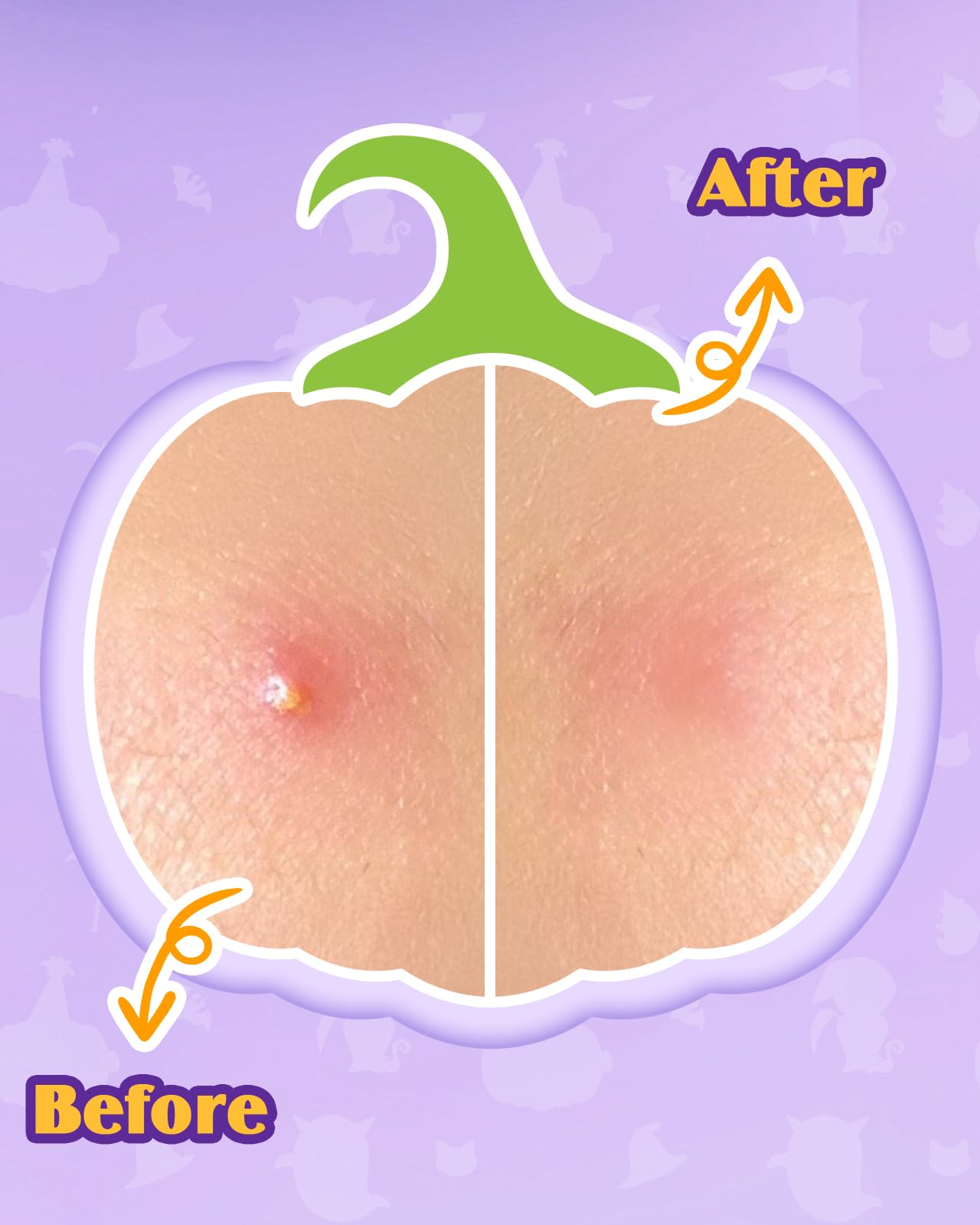 Attyxfica Halloween Acne Pimple Patches Cute - 144 Count Hydrocolloid Pimple Patches for Face, Spot Treatment Stickers w/Salicylic Acid & Tea Tree Oil for Zits and Blemishes, 2 Sizes & 12 Patterns