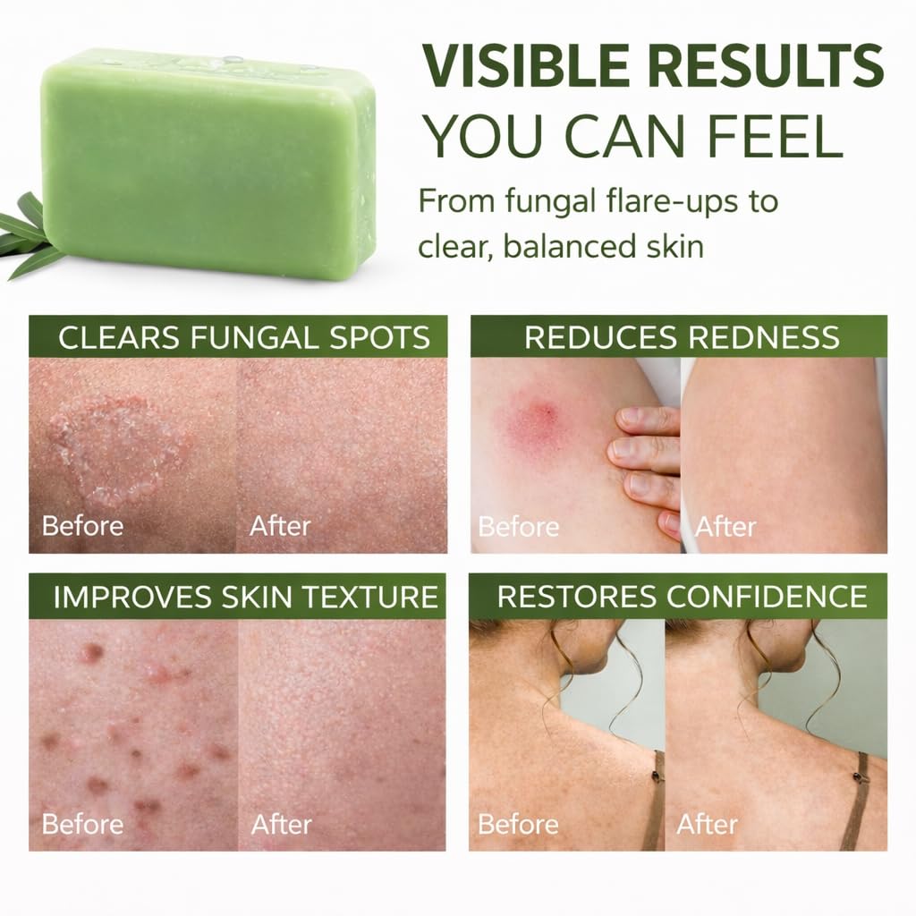 Youth Research Oraliyne Antifungal Soap, with Tea Tree Oil & Coconut Oil ，for Athlete's Foot, Jock Itch, Skin Fold Intertrigo (1pc)