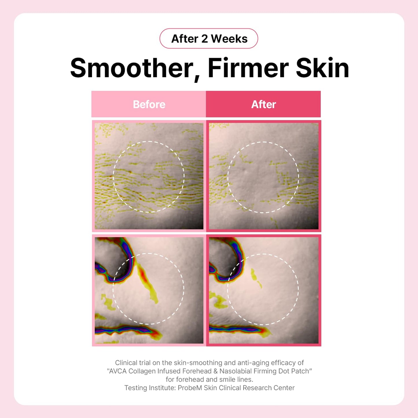 AVCA Collagen Dot Patches for Forehead Wrinkles – Korean Overnight Firming Patch for Smile Lines & Crow's Feet – Adenosine, Peptide & Hyaluronic Acid, 25 patches