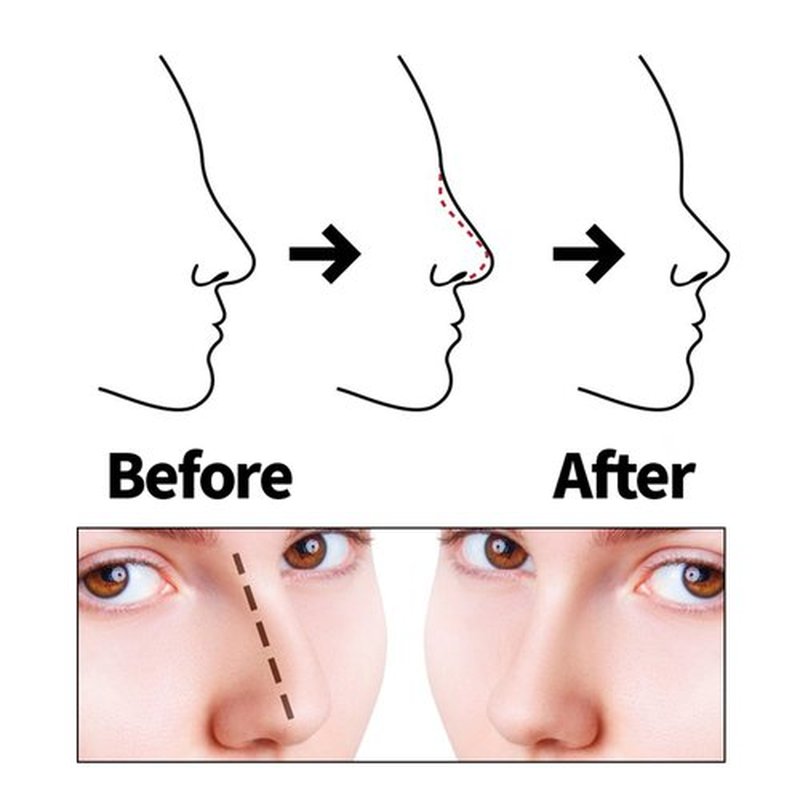 SOZOOM PDO Thread Nose Lift, PDO Cog Threads Improve the Shape of the Nasal Columella and Alar L-Blunt Type Cog Thread Lift (16pcs-19G-60mm (l))