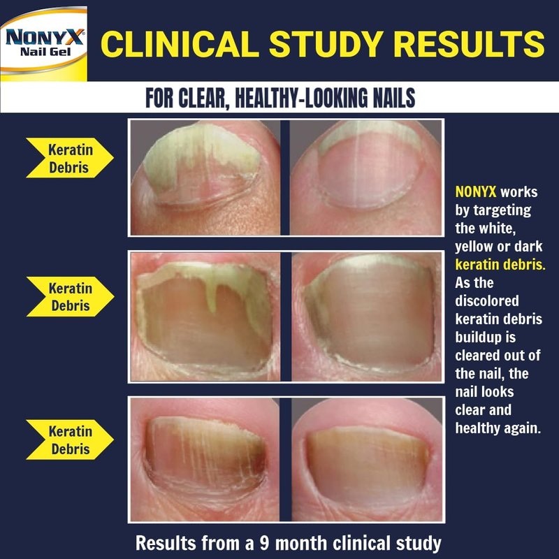 NONYX Fungal Nail Clarifying Gel - Clinically Proven Treatment for Discolored, Thick, and Brittle Toenails | 90% Improvement Rate