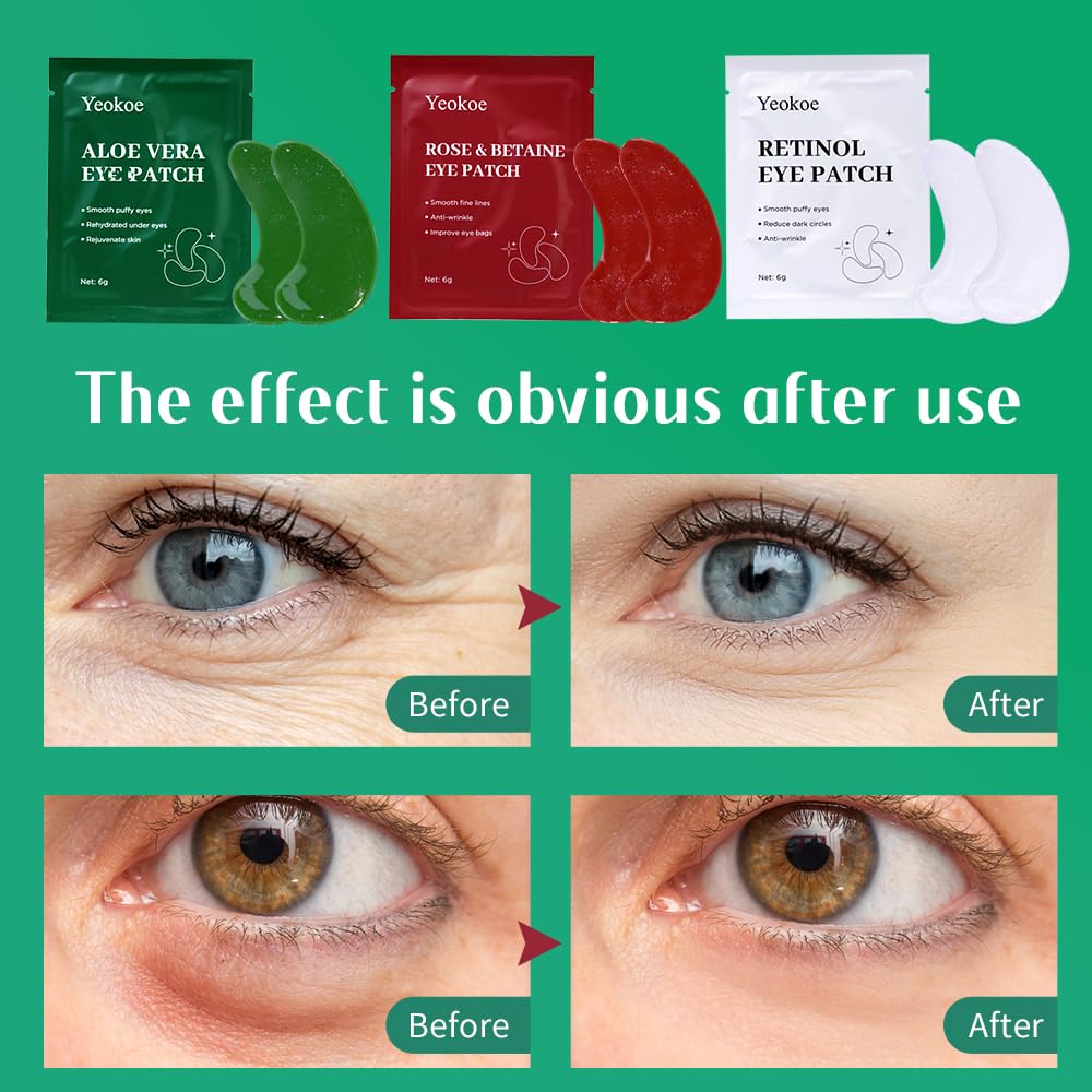 Yeokoe Under Eye Patches For Puffy Eyes and Dark Circles Wrinkle,30 Pairs Face Masks SkinCare With Retinol Serum,Aloe Vera,Rose Betaine