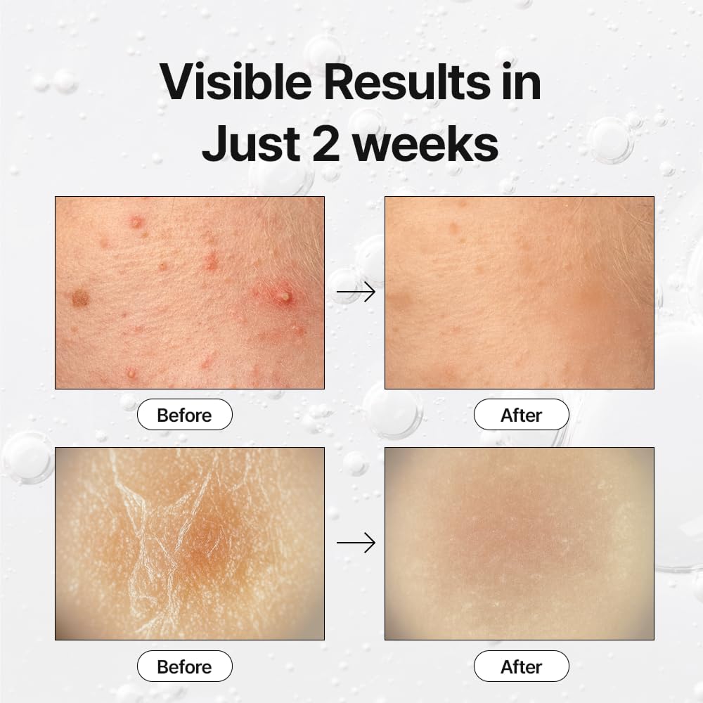 K-Beauty Exosome Reset Ampoule – Gentle Exfoliating, Pore-Clearing & Blemish-Calming Serum for Sensitive Skin | Daily Clarifying Step (30ml)