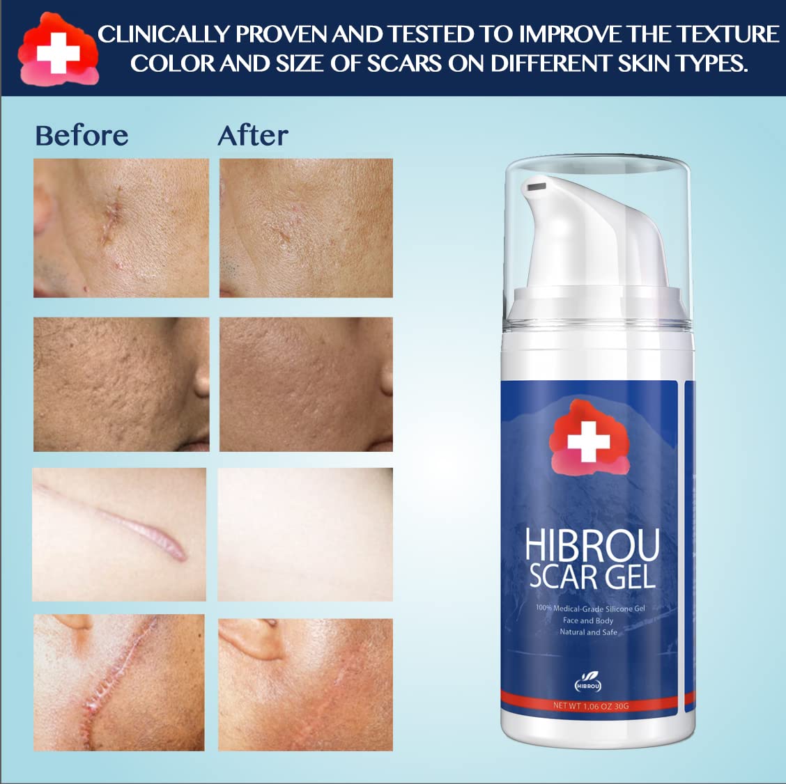HIBROU Advanced Silicone Scar Gel - Medical Grade Scar Treatment for Old & New Scars, Acne, Surgery, Burns & Stretch Marks - Face & Body - 1 oz.