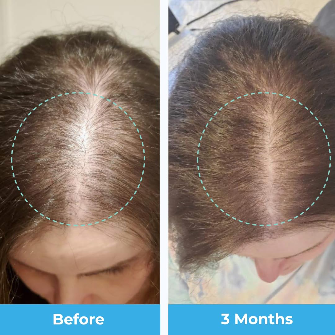 Baby Blues Postpartum Hair Loss Vitamins & Gummies for Women, Biotin & Collagen for Hair Growth Support, Thinning Hair Support, Thicker Fuller-Looking Hair, Hair Skin & Nails, Postnatal, 60 Count