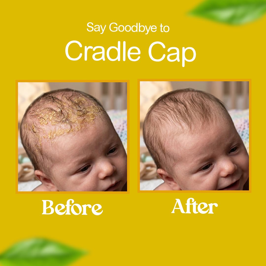 BELLA B Bee Gone Cradle Cap Baby Shampoo Treatment, 8 oz, Organic Natural Dry Scalp Shampoo For Babies