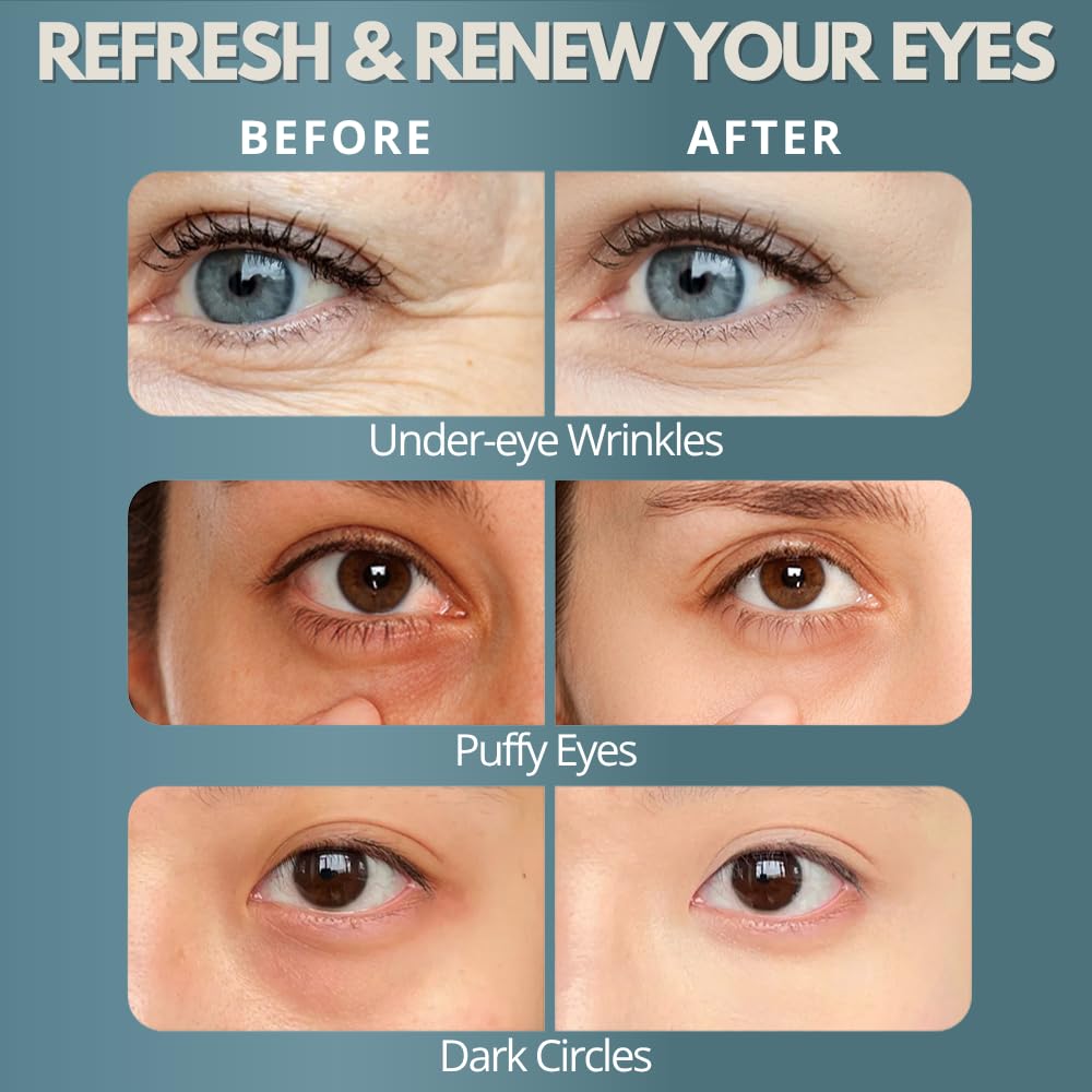 ZEENCARE Under Eye Red Light Therapy, Rechargeable Dark Circles Under Eye Treatment, Red Light Therapy for Eyes Wrinkles Puffy Fine Lines