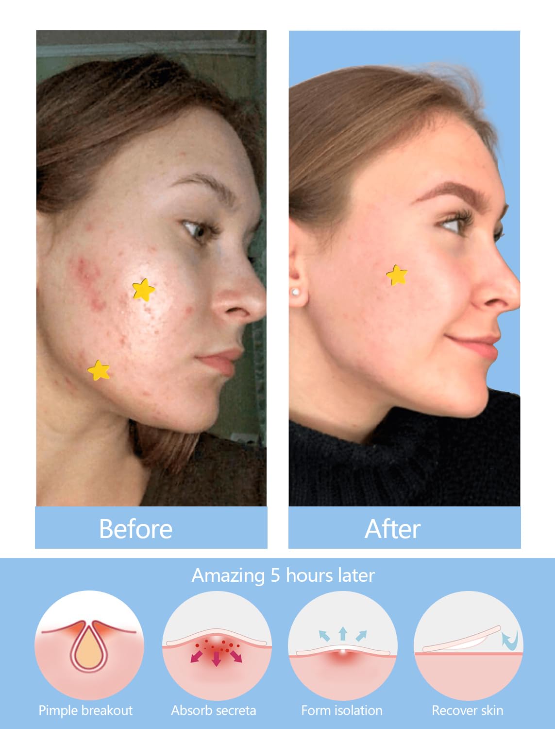 SVIPTP Yellow Star Pimple Patches for Face, 153 Count Hydrocolloid Star Acne Patches Invisible, Cute Zit Covers for Face, Spot Stickers with Tea Tree, Salicylic Acid and Cica Oil