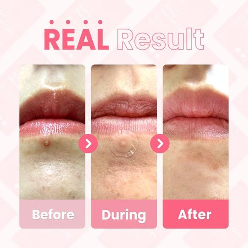 GLAM UP Hydrocolloid Blemish Pimple Zit Patches(180PCS/2Size) - Invisible Ultra Thin Spot Cover Stickers for Face and Skin, Strong Water-proof and Adhesive Overnight, Vegan-friendly