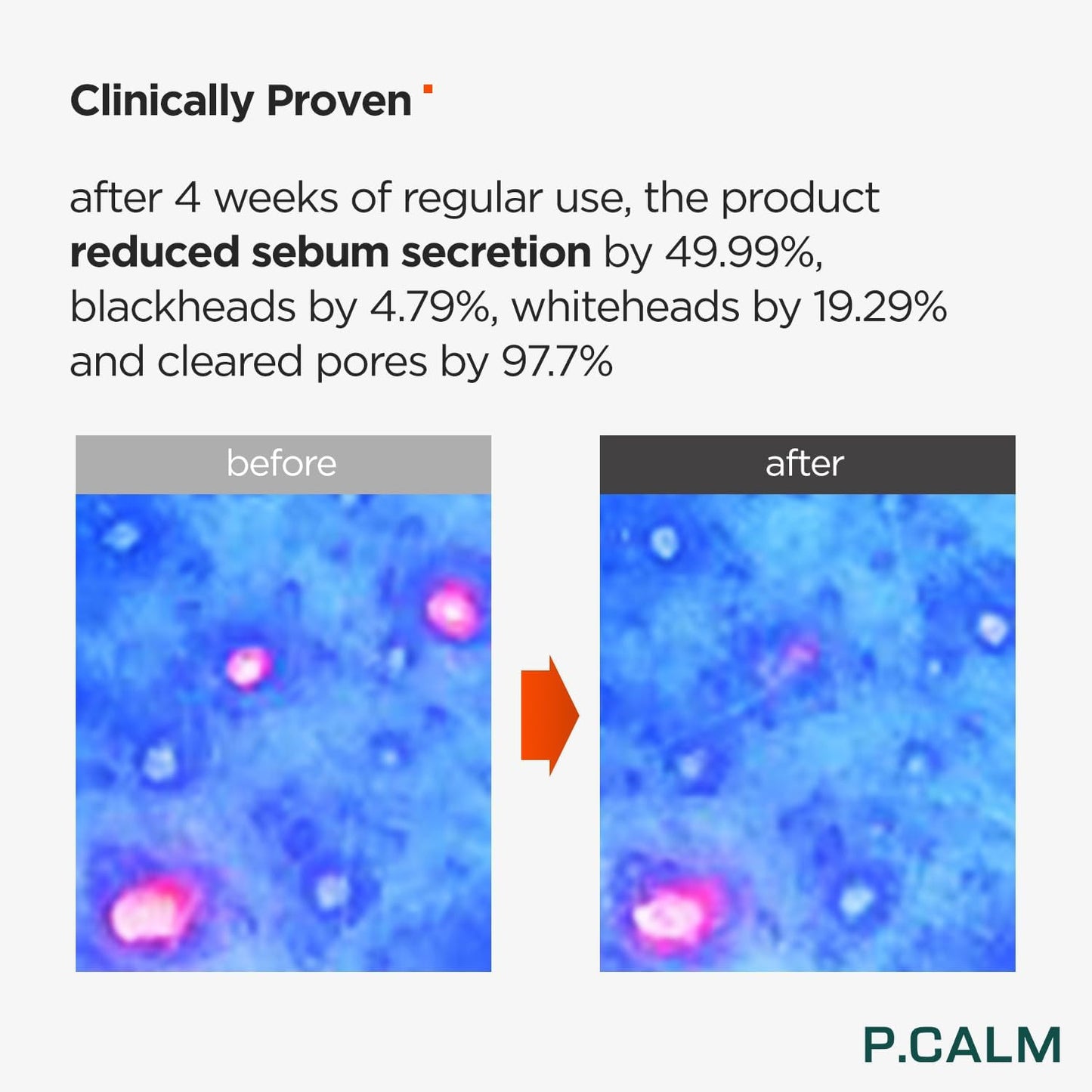P.CALM Underpore Foam Cleanser – Azulene for Deep Pore Cleansing, Blackhead & Whitehead Removal, Korean Vegan Facial Wash for Sensitive Skin (150ml / 5.07 fl.oz)