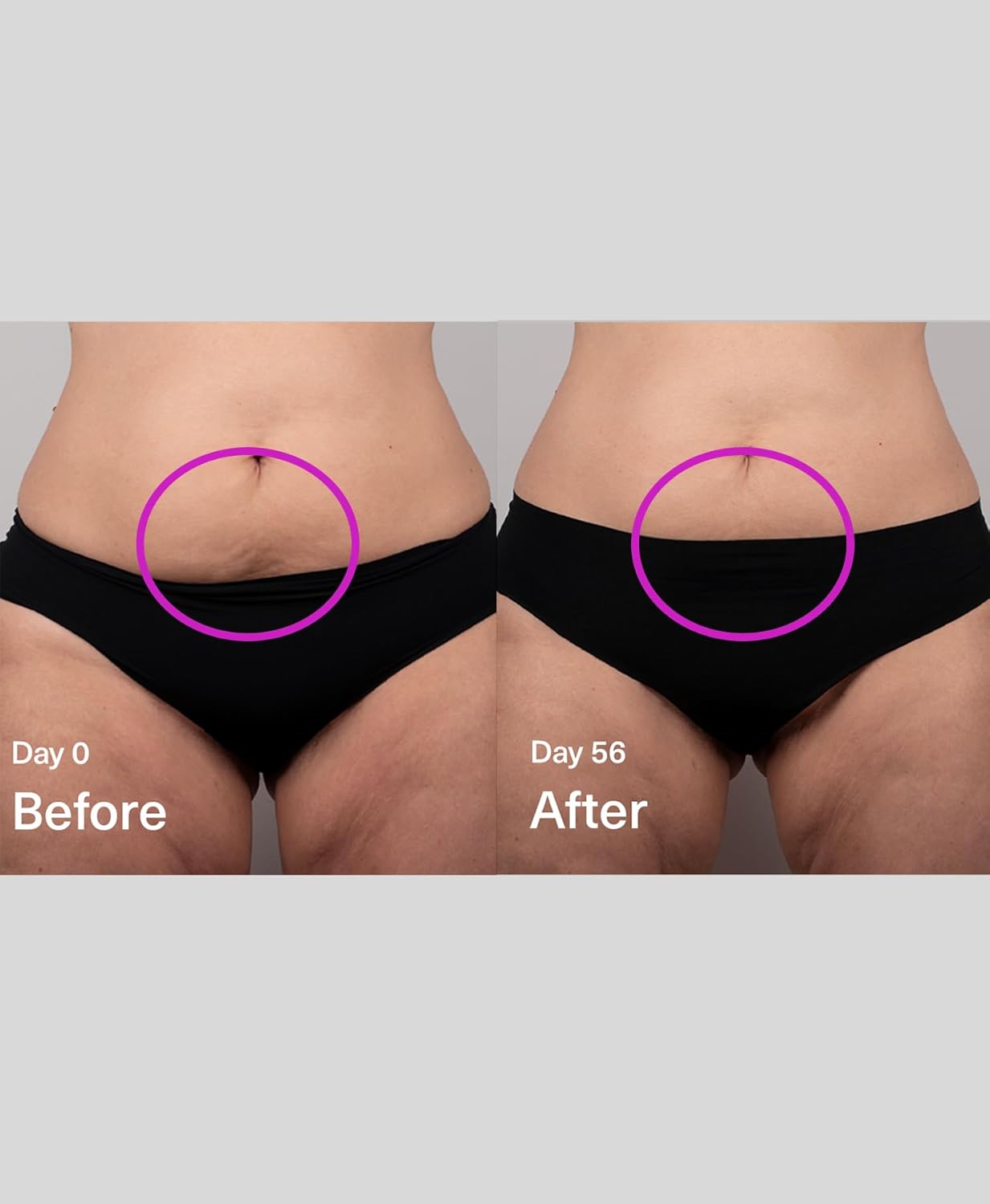 SickScience Advanced Exosome Body Firming Cream - Targets Stretch Marks & Cellulite | 100ml