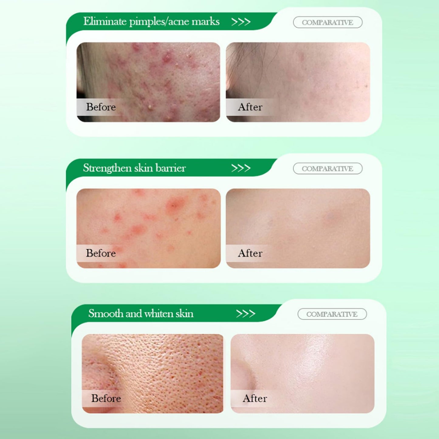 Grospe Salicylic Acid Repair Cream,Salicylic Acid Face Moisturizer,Pore Shrinkage Acne Skin Improves Acine Scars Motsturizing,Suitable for Oily, Acne Prone Skin 50g
