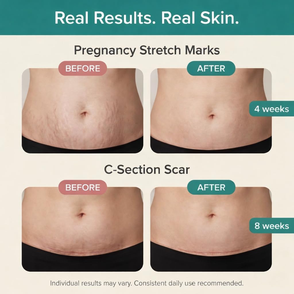 The Vibrant Glow Pregnancy Stretch Mark Oil | Deep Hydration for Stretching Skin | Formulated with Pure Blend Oil, Rosehip, Vitamin E & C and Argan-Oil | Dermatologist Tested for C-Section Scars, 2 OZ