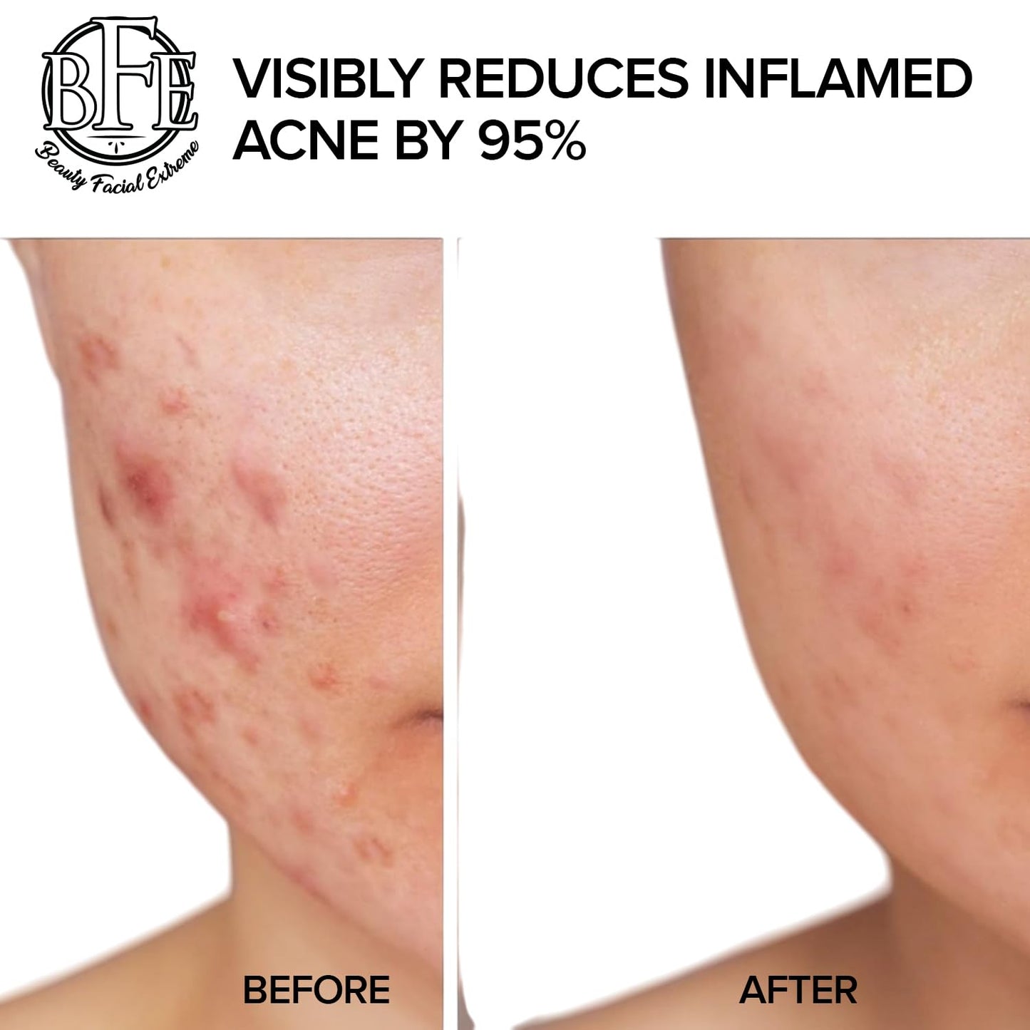 Acne Treatment Pads- Eliminates Cystic Breakouts, Oily Skin & Clogged Pores. Clear Pimple, Whitehead, Blackhead, Dark Spots & Improve Skin Texture.