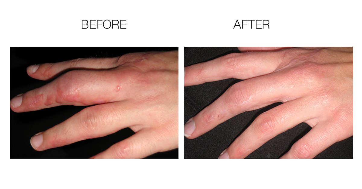 ScarFade Elite Advanced Scar Treatment, Scar Removal, Scar Therapy, Scar Prevention, Anti Scar Gel with Silicone & Vitamin C -15g