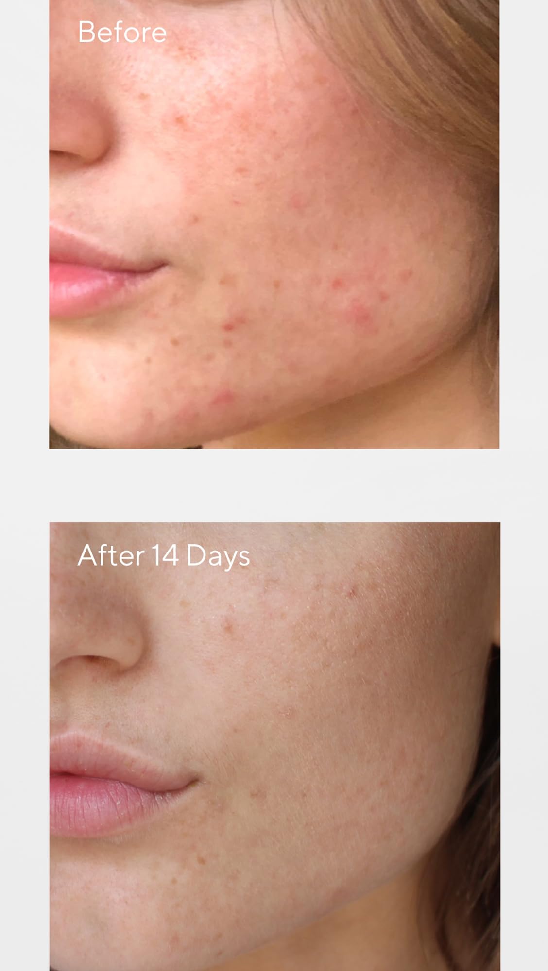 Murad Women's Invisiscar Resurfacing Treatment