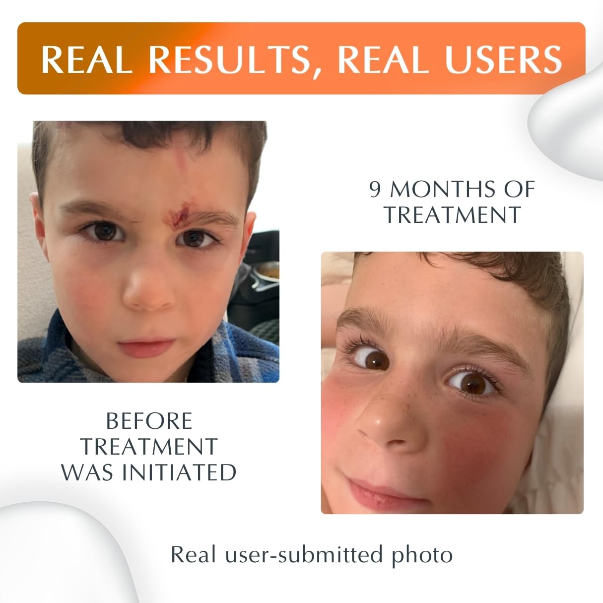 MyNewGel Plus UV Advanced Silicone Scar Gel | Old & New Scars | SPF30 Mineral non-chemical Sunscreen | Ideal for Protecting Scars | Harmful Ultraviolet Rays, 15g (0.5 oz)