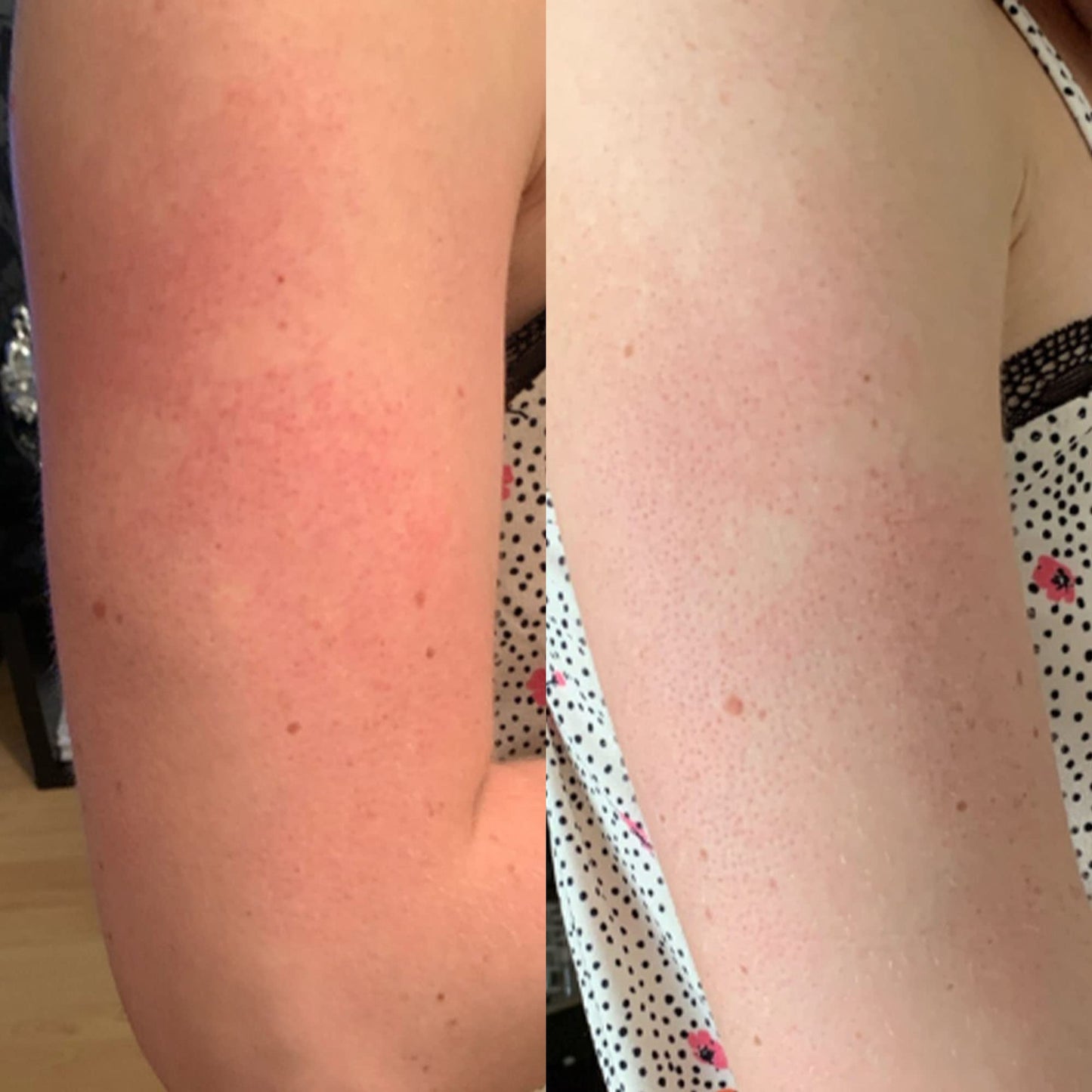 AMELIORATE Transforming Body Lotion for Keratosis Pilaris, 500ml