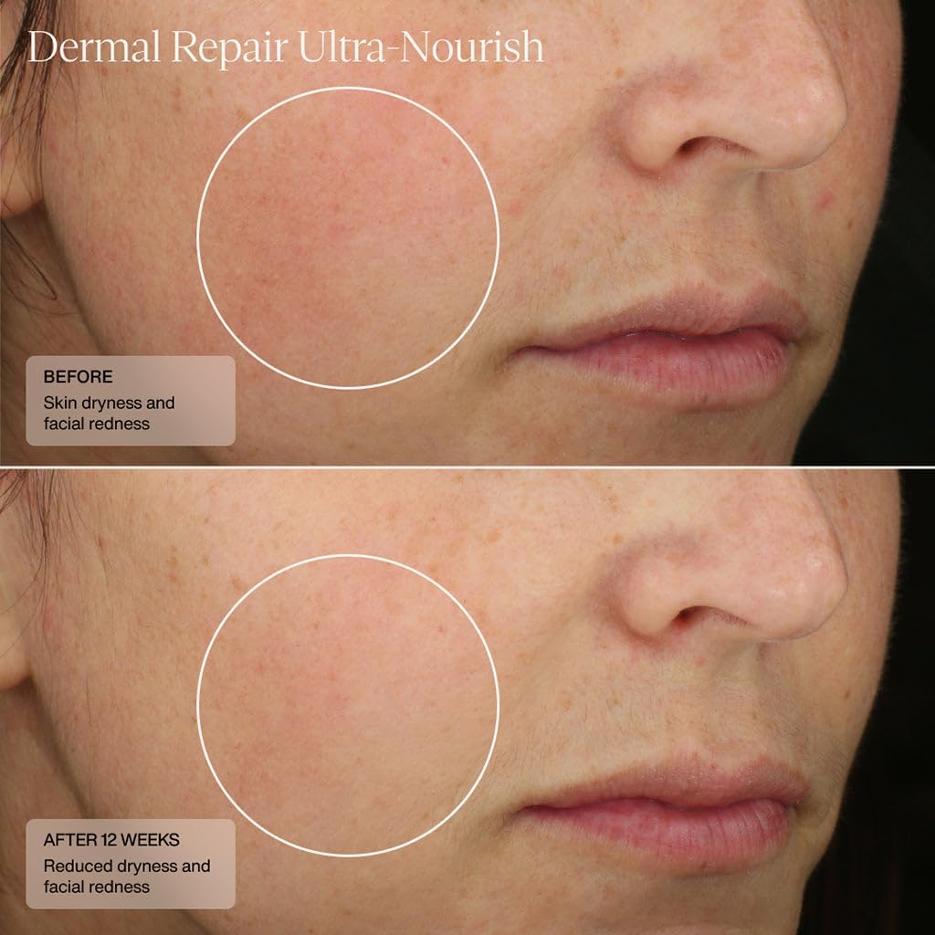 Senté Dermal Repair Ultra-Nourish | Rosacea Treatment for Dry, Sensitive Skin | Repairs, Replenishes & Reduces Skin Redness | 1.7 Fl Oz