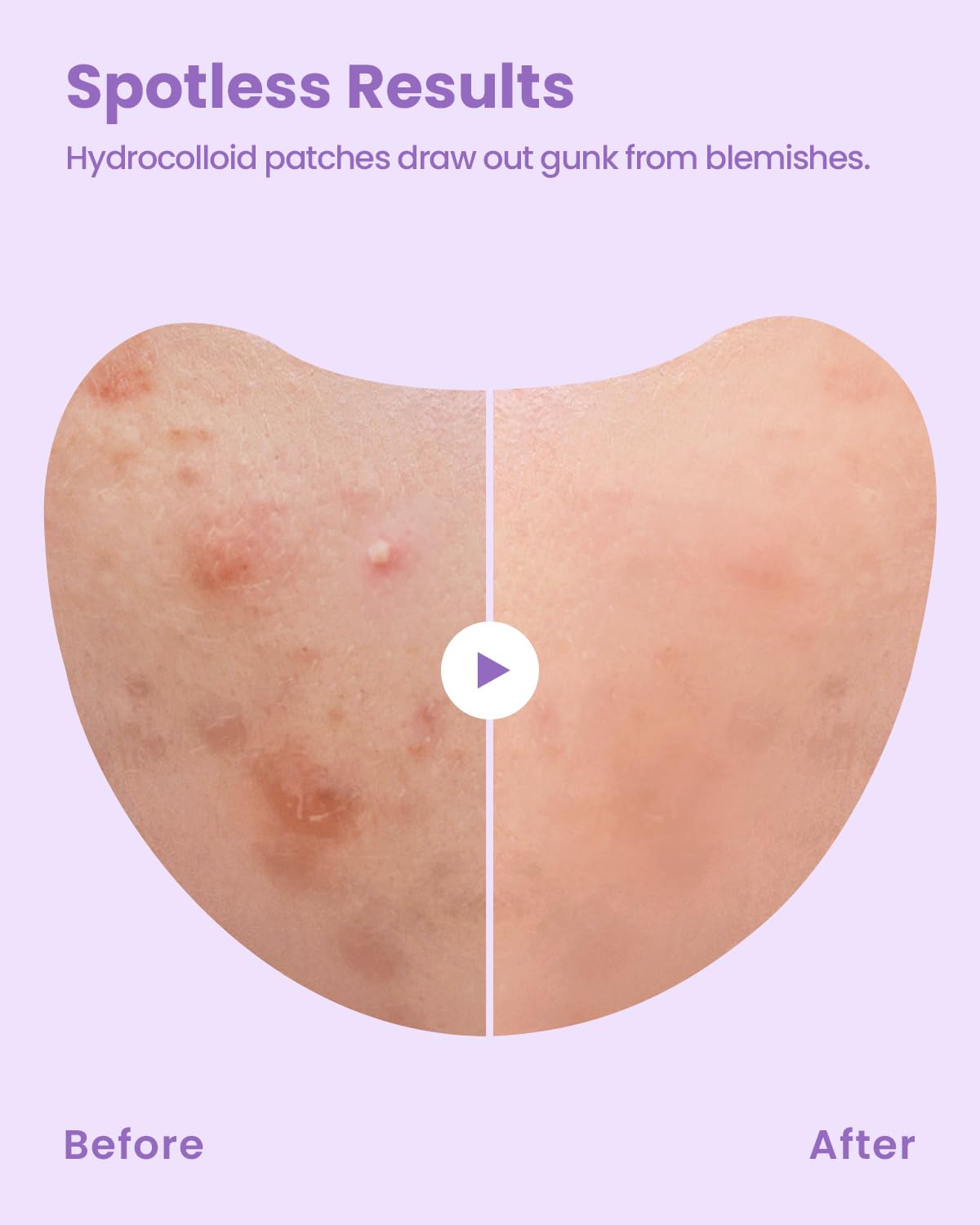 GLAM UP Spotless Patch - Hydrocolloid Spot Patch for Wide Acne area, Cheek, Body, Blackhead Cruelty Free and Vegan Friendly (12 Count)