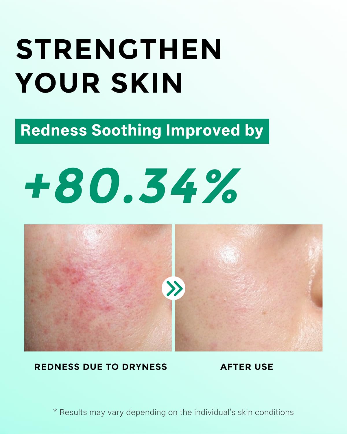Azelaic Acid Serum,10% Azelaic Acid for Face – 20,000ppm Niacinamide, 5,000ppm Vitamin B5 – Centella Asiatica & Hyaluronic Acid - Soothe Redness, Refine Texture, and Hydrate, Korean Skincare 1 Fl Oz