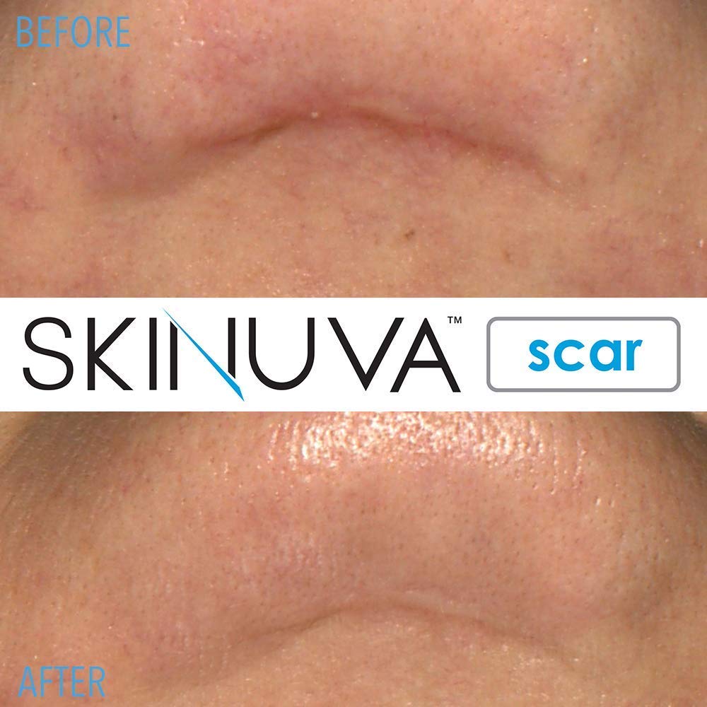 Skinuva® Scar Cream for Face & Body (1.5 oz)