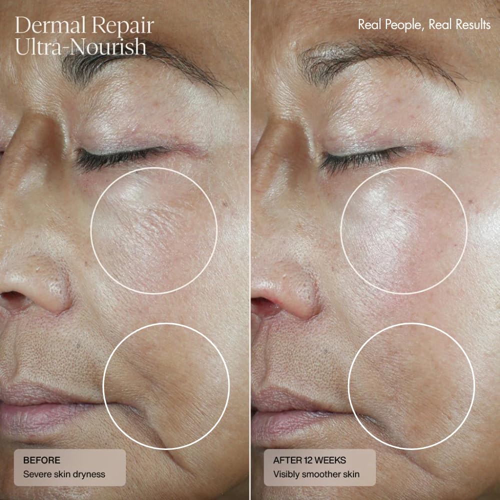Senté Dermal Repair Ultra-Nourish | Rosacea Treatment for Dry, Sensitive Skin | Repairs, Replenishes & Reduces Skin Redness | 1.7 Fl Oz