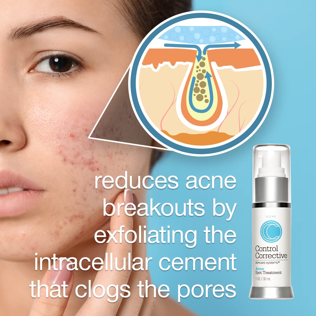 CONTROL CORRECTIVE Acne Spot Treatment Gel – 2% Salicylic Acid Formula for Breakouts & Blemishes – With Witch Hazel, Aloe & Panthenol – 1 oz Clear Skin Serum