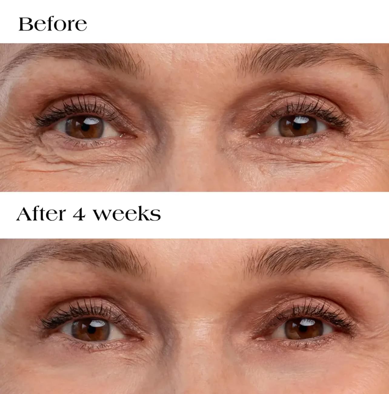 Hyaluronic Acid Collagen Micro Anti-Wrinkle Patches for Dark Circles, Bags, Crapey & Creased Skin, Anti-Aging, Firms, Smooths, Lifts, Lightens, 0.25mm Dissolvable Nanocrystal Darts, 6 Patches