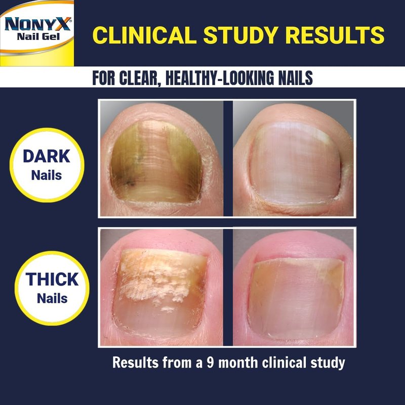 NONYX Fungal Nail Clarifying Gel - Clinically Proven Treatment for Discolored, Thick, and Brittle Toenails | 90% Improvement Rate