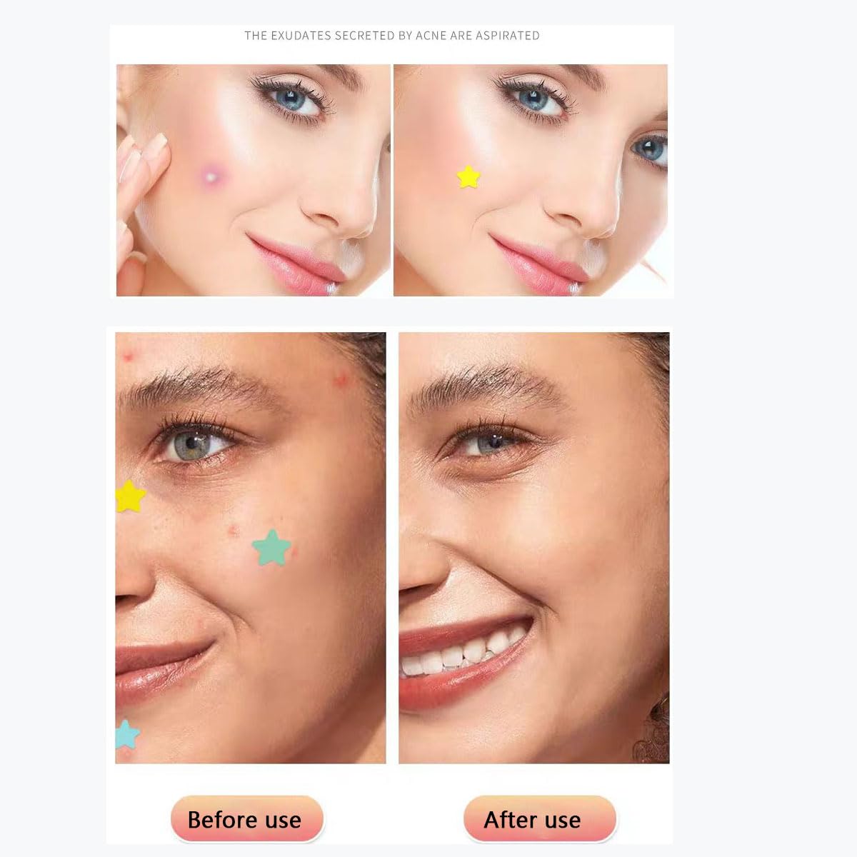 Pimple Patches for Face, 153 pcs Acne Patches, Cute Zit Covers for Face, Spot Stickers with Tea essential oil ， Salicylic Acid and Cica Oil